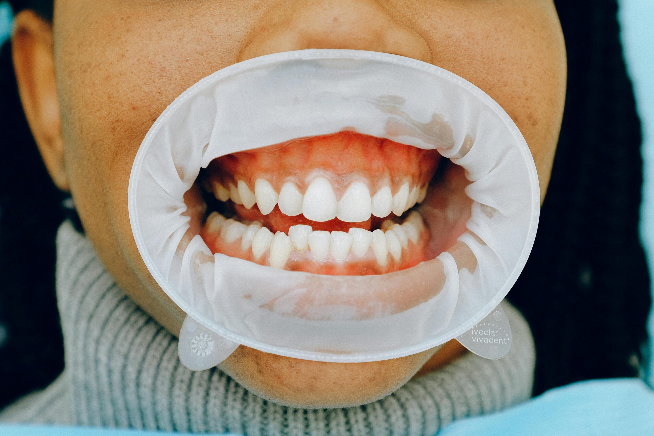 Zahnfleischentzündung geht nicht weg - Ursachen und Tipps